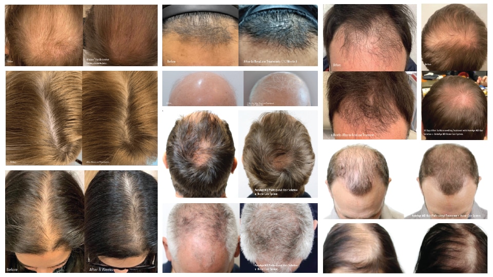 Keralase™ (Hair & Scalp) (Series of 6)