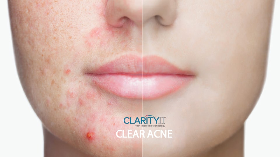 Clarity II™ Clear Acne