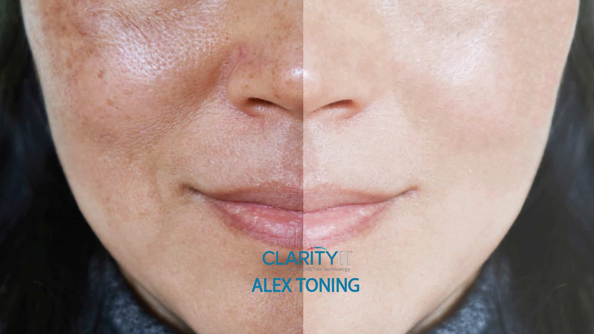 Clarity II™ Alex Toning