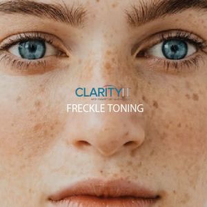 Clarity II™ Freckle Toning