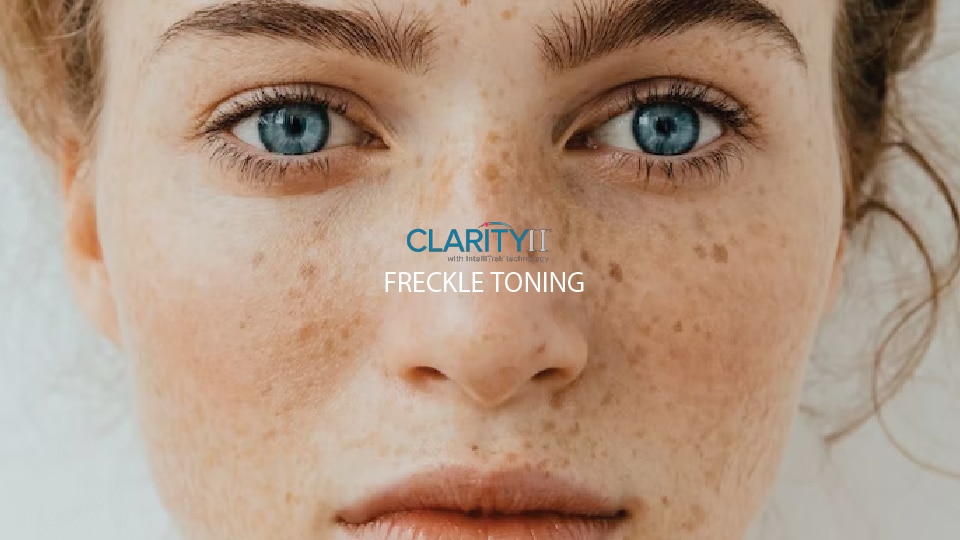 Clarity II™ Freckle Toning