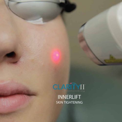 Clarity II™ InnerLift™ (Laser Genesis)