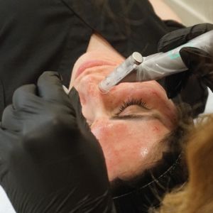Microneedling (Face+Neck)