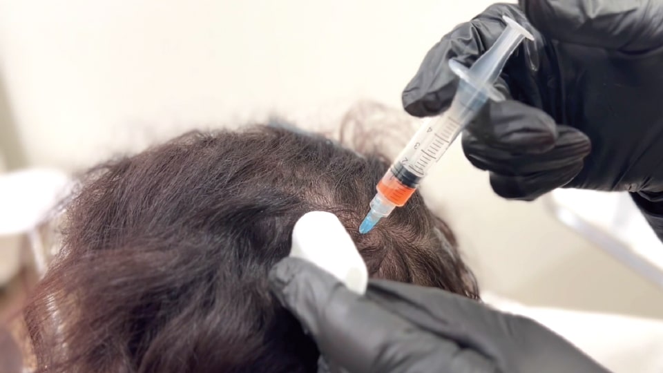 Platelet Therapy (Hair)