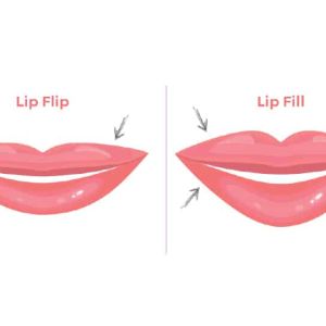 Neurotoxin | Lip Flip